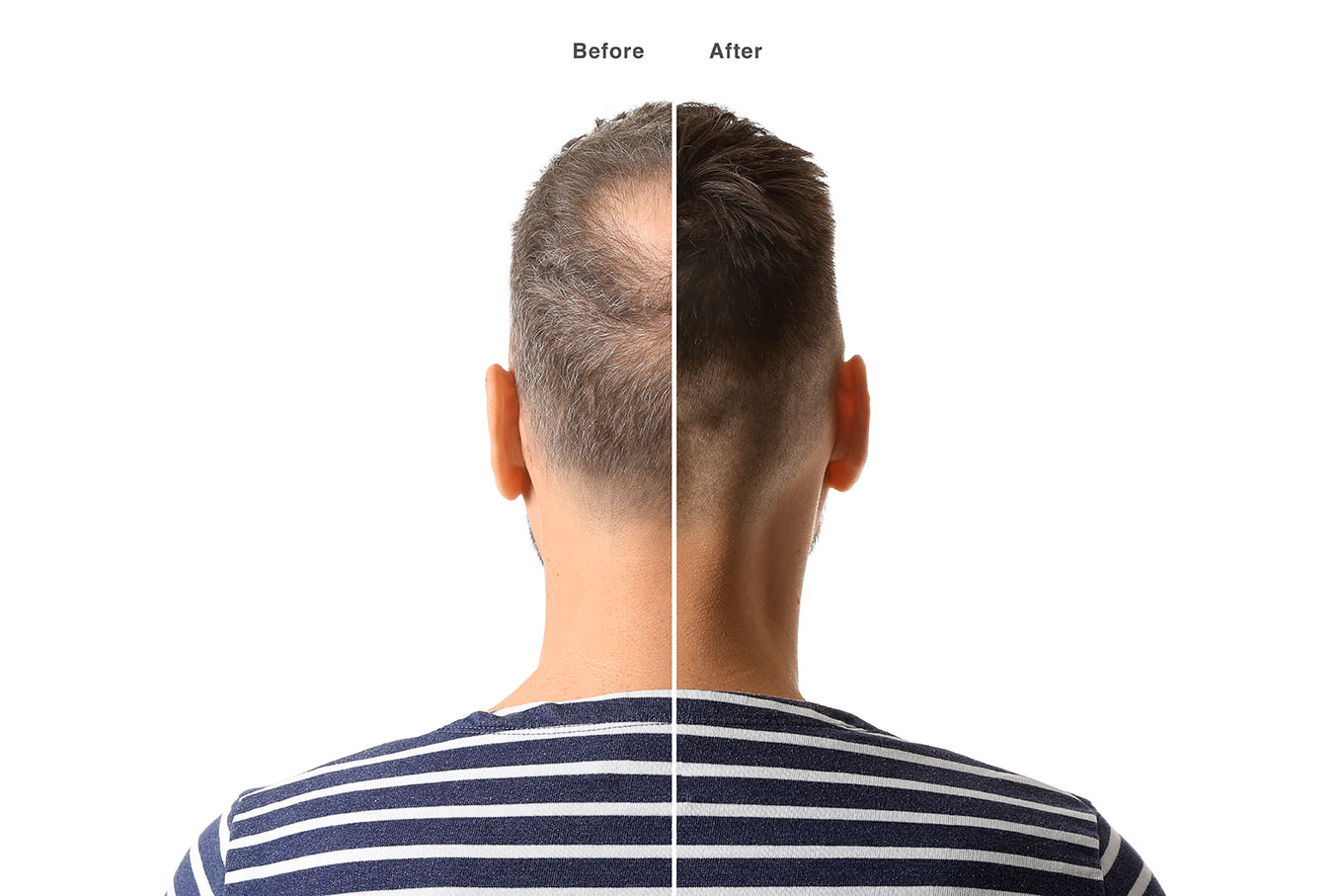 Alopecia Treatment