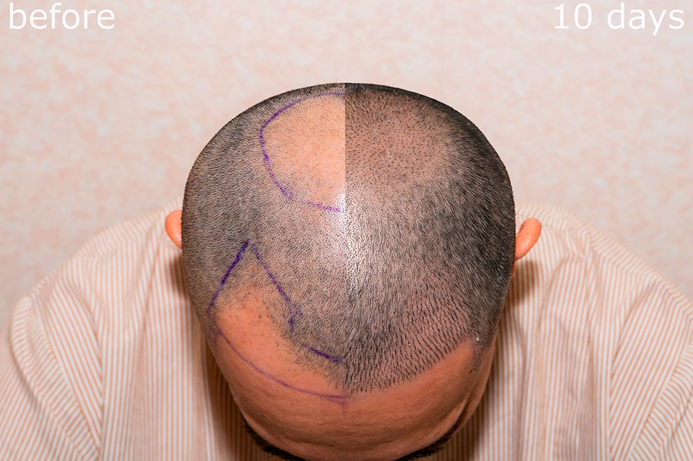 Men’s FUE Hair Transplant