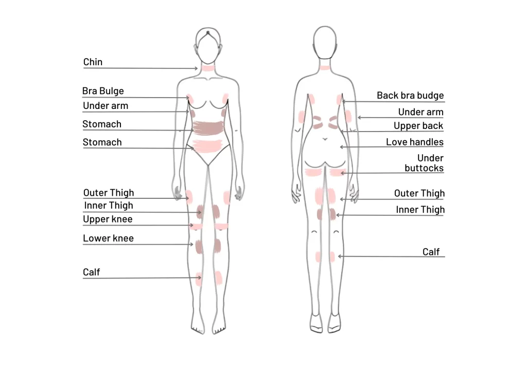 Areas Treated with Cryolipolysis