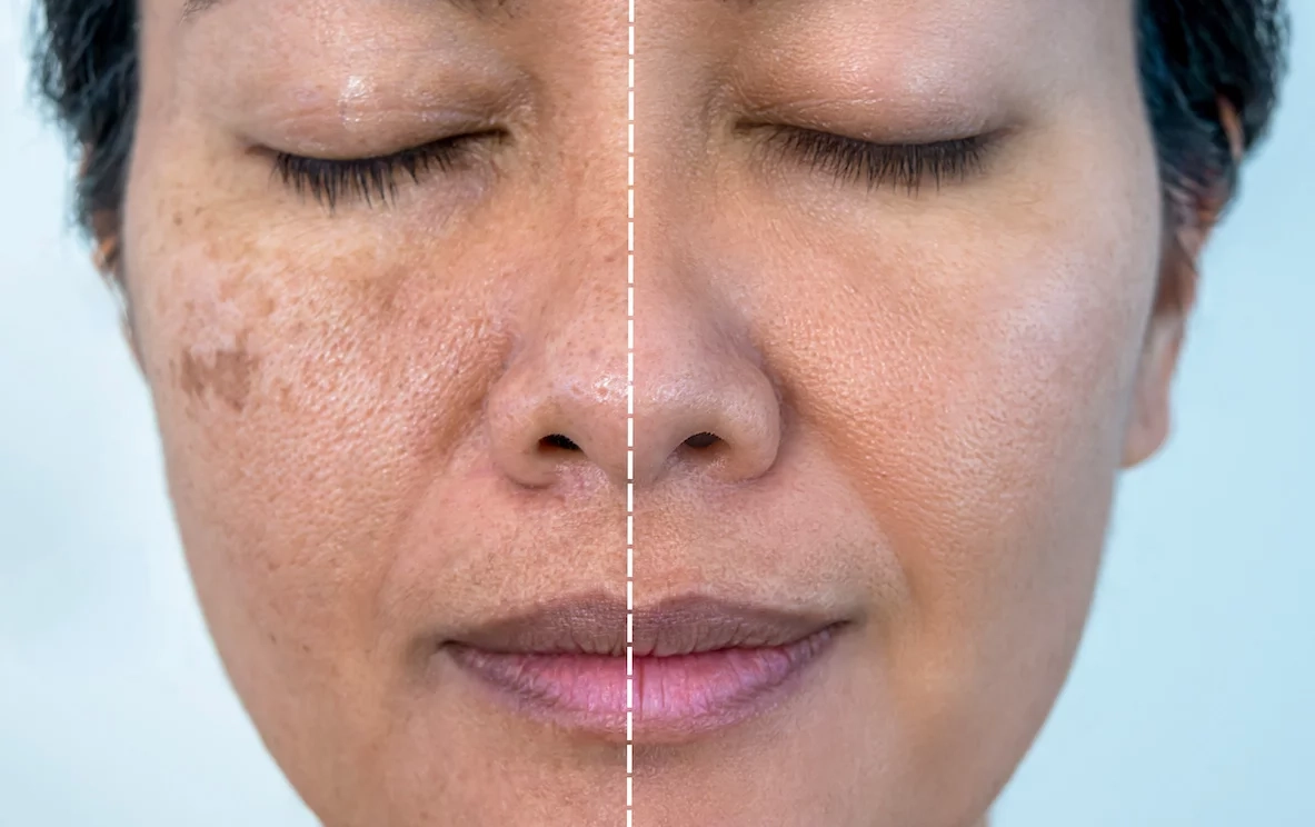 Melasma Treatment
